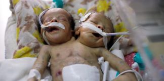 Yemeni conjoined twins die in blockaded Sanaa: rebels