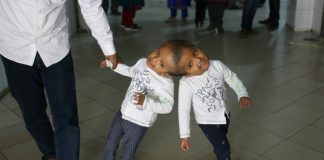 Hungarian doctors separate Bangladeshi twins joined at head