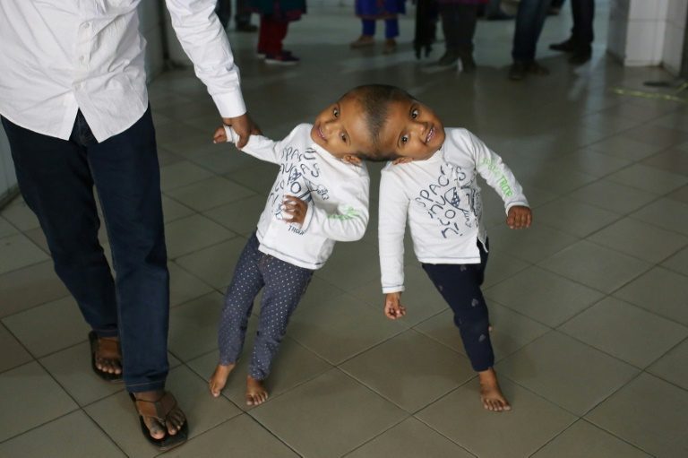Hungarian doctors separate Bangladeshi twins joined at head