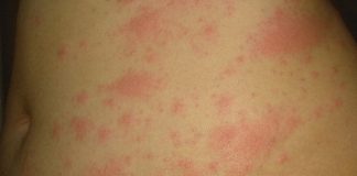 SKIN DEEP Skin rash IS coronavirus sign and should be fourth official symptom, experts warn – the 8 different types revealed