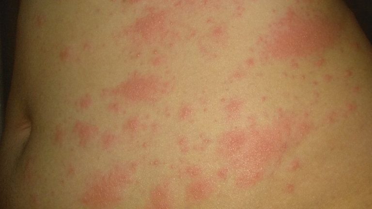 SKIN DEEP Skin rash IS coronavirus sign and should be fourth official symptom, experts warn – the 8 different types revealed