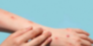 Risk of more Monkeypox infected people coming to Sri Lanka